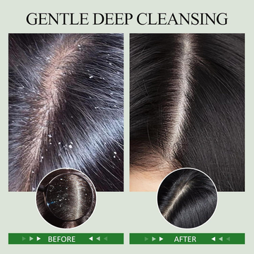 Hyper Deep Cleansing Scalp Scaler – Deep Cleanse. Healthy Scalp. Stronger Hair – Micro-Bubble Technology Removes Dirt & Dead Skin – Anti-Hair Loss, Dandruff Control, Sebum Balance