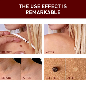 Acne & Acne Scars Removal Cream – Fast Acne Treatment, Fades Scars, Controls Oil & Bacteria – Suitable for Face, Back & Neck